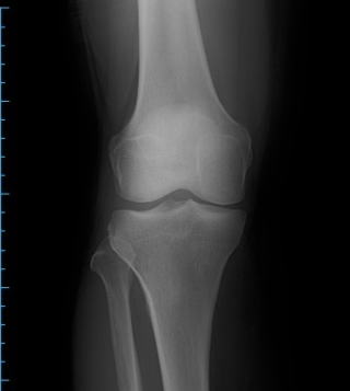 膝X線画像